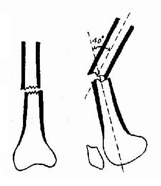 股骨下1／3横行骨折，两骨块成角40