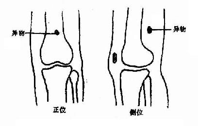 异物定位，正位及侧位摄片法