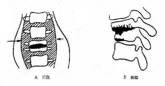 第1.2腰椎结核