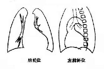 高血压心脏病