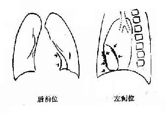 缩窄性心包炎