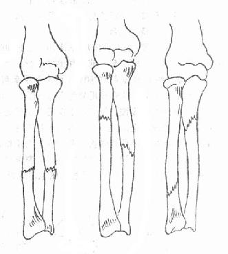 尺桡骨双骨折