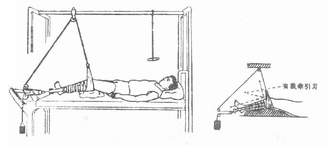 动滑车皮肤牵引法（Russell氏法）