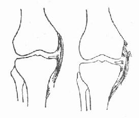 内侧副韧带部分断裂
