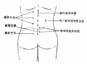 常见腰痛压痛点