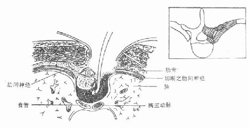 胸椎结核合并截瘫，前外侧病灶清除及减压术。