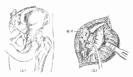 骶髂关节结核病灶清除术，后显露法