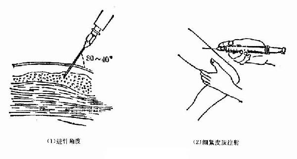 皮下注射部位