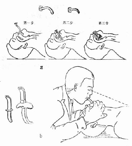 通过S形塑管进行口对口呼吸