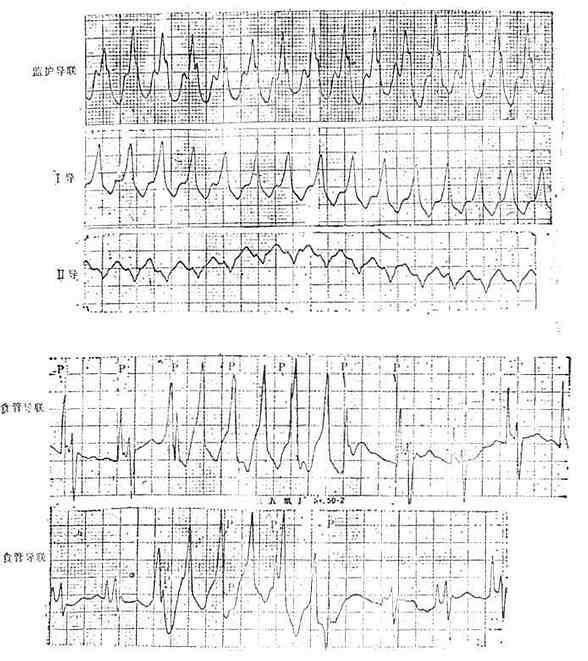 食管导联心电图室速。显示心房电活动波群（P）