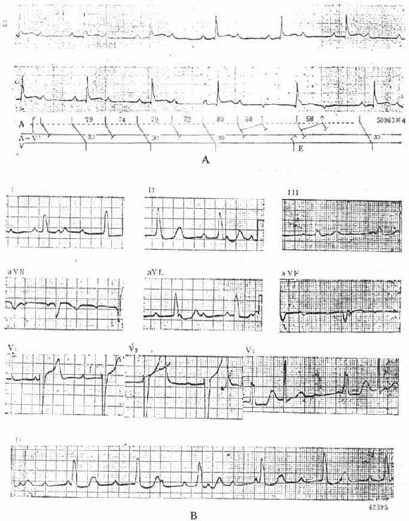 Ⅱ度及Ⅲ度房室传导阻滞的心电图