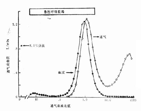 通气/血流灌注失调