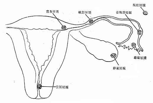 宫外妊娠的部位