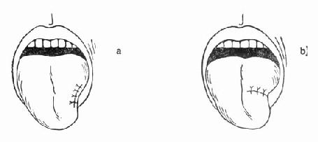 舌损伤的处理