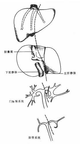 劈离式肝移植供肝分离