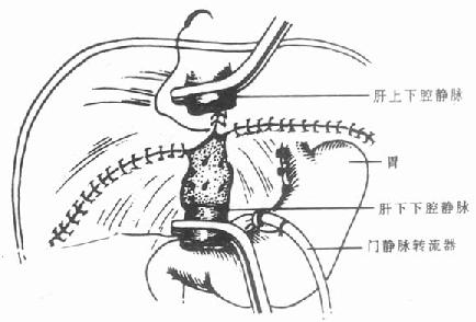 肝脏切除后腹腔情况