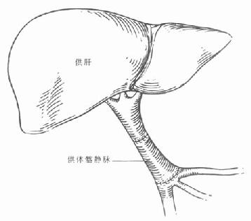 经供体骼静脉搭桥门静脉吻合