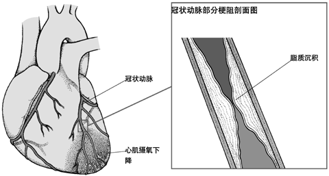 冠状动脉内脂质沉积