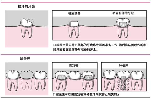 桩冠、固定桥和种植体