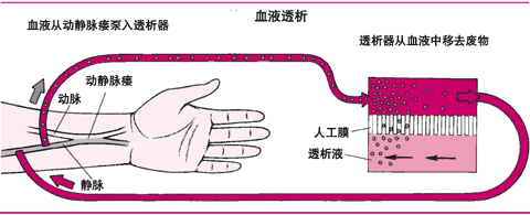 血液透析