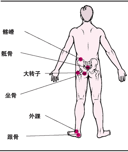 褥疮的常见部位