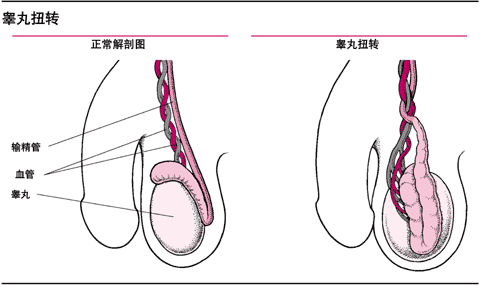 睾丸扭转