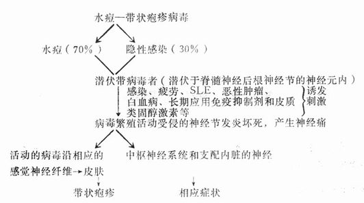 带状疱疹