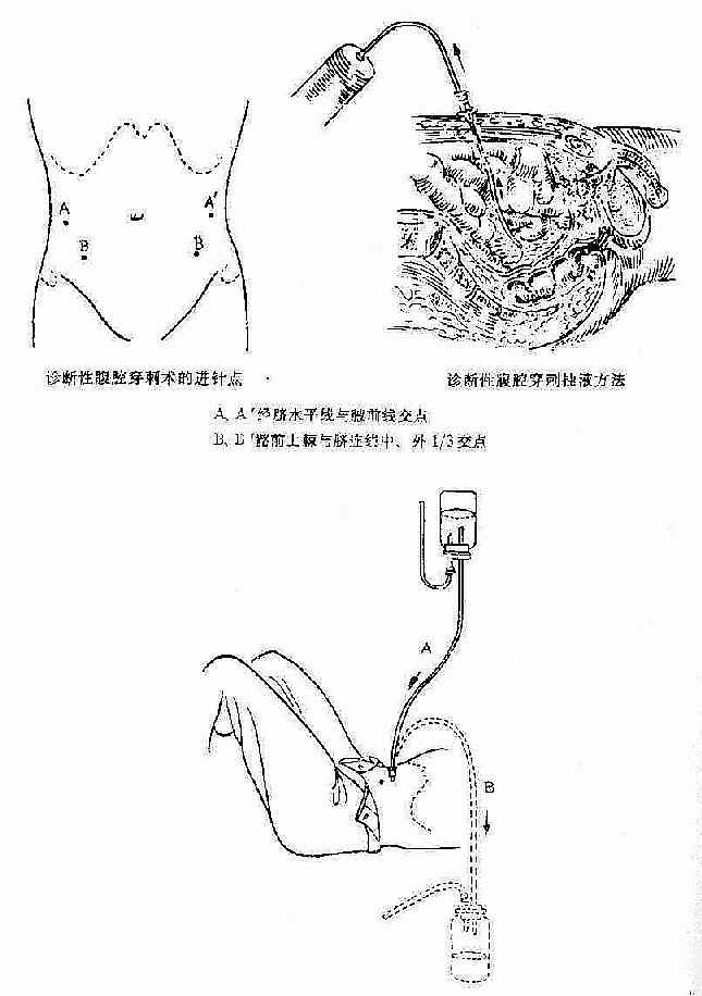 诊断性腹腔浣洗术