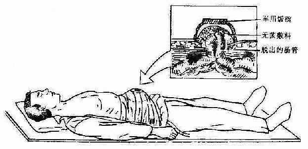 腹部火器伤急救包扎法
