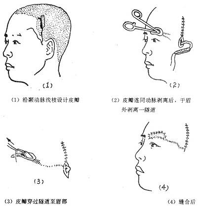 岛状皮瓣眉再造术