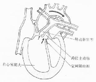  法洛四联症